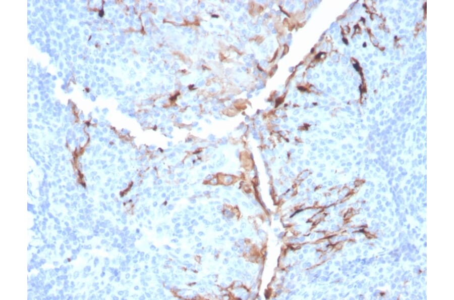 Immunohistochemistry - Anti-Mesothelin Antibody [MSLN/3384] - BSA and Azide free (A251263) - Antibodies.com