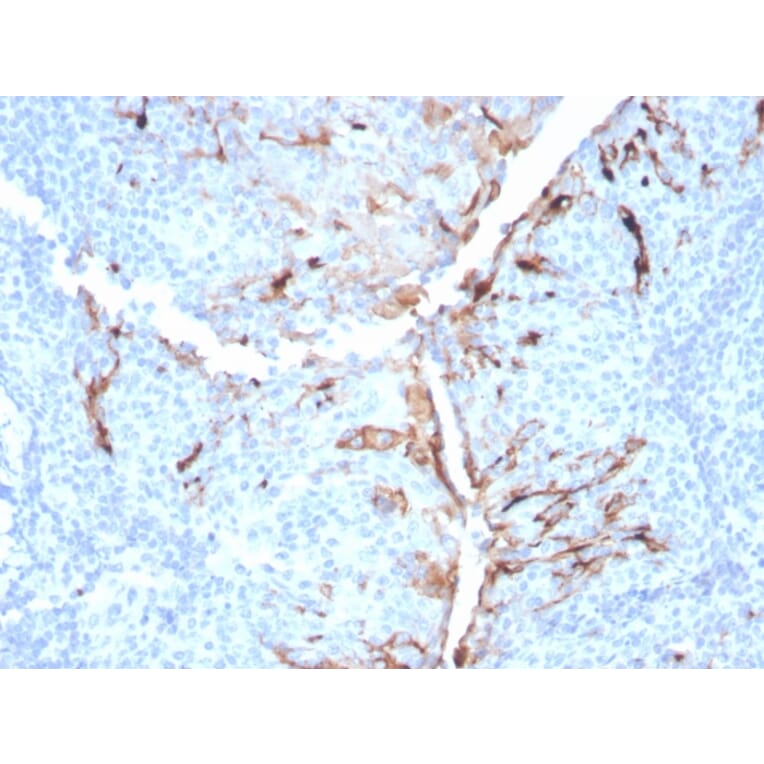 Immunohistochemistry - Anti-Mesothelin Antibody [MSLN/3384] - BSA and Azide free (A251263) - Antibodies.com