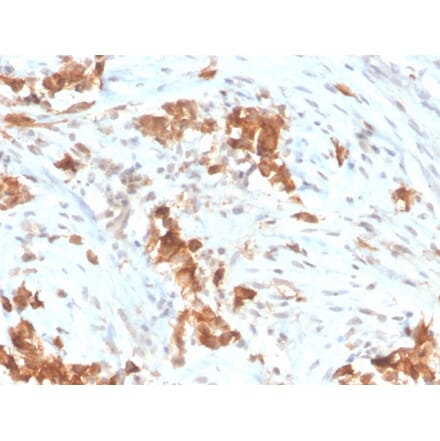 Immunohistochemistry - Anti-Mesothelin Antibody [MSLN/3385] - BSA and Azide free (A251264) - Antibodies.com