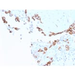 Immunohistochemistry - Anti-Mesothelin Antibody [MSLN/3387] - BSA and Azide free (A251265) - Antibodies.com