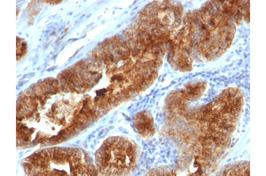 Immunohistochemistry - Anti-TAG72 Antibody [B72.3 + CC49] - BSA and Azide free (A251544) - Antibodies.com