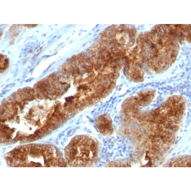 Immunohistochemistry - Anti-TAG72 Antibody [B72.3 + CC49] - BSA and Azide free (A251544) - Antibodies.com