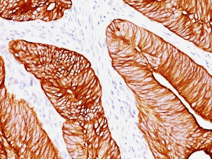 Immunohistochemical analysis of formalin-fixed, paraffin-embedded human colon carcinoma using Anti-Cytokeratin 8 Antibody [K8.8].