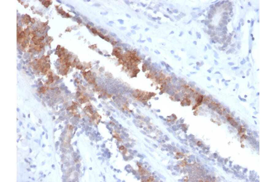 Immunohistochemistry - Anti-Mammaglobin A Antibody [MGB/2123R] - BSA and Azide free (A252505) - Antibodies.com