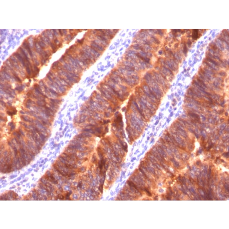 Immunohistochemistry - Anti-MUC1 Antibody [MUC1/520] - BSA and Azide free (A252579) - Antibodies.com