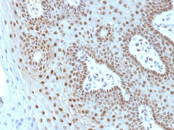 Immunohistochemical analysis of formalin-fixed, paraffin-embedded human cervical carcinoma using Anti-c-Myc Antibody [MYC275 + MYC909].