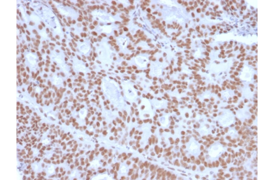 Immunohistochemistry - Anti-Progesterone Receptor Antibody [PGR/2694] - BSA and Azide free (A252799) - Antibodies.com
