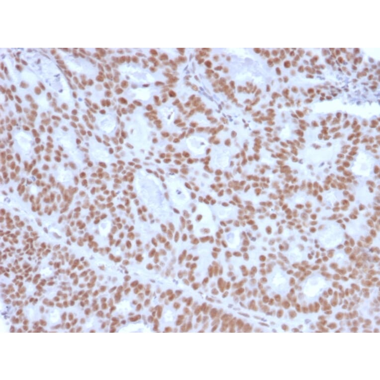 Immunohistochemistry - Anti-Progesterone Receptor Antibody [PGR/2694] - BSA and Azide free (A252799) - Antibodies.com