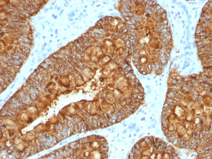 Immunohistochemical analysis of formalin-fixed, paraffin-embedded human colon carcinoma using Anti-MAML3 Antibody [MAML3/1303].