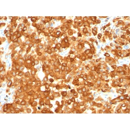 Immunohistochemistry - Anti-Melanoma gp100 Antibody [HMB45] - BSA and Azide free (A253146) - Antibodies.com