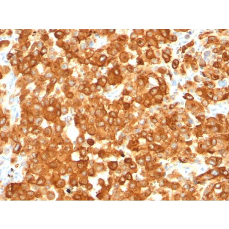 Immunohistochemistry - Anti-Melanoma gp100 Antibody [HMB45] - BSA and Azide free (A253146) - Antibodies.com
