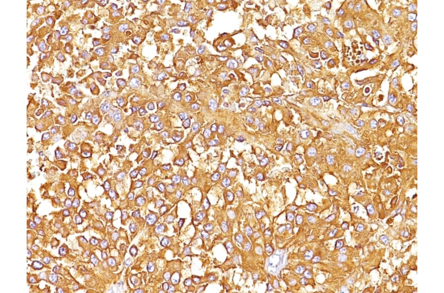 Immunohistochemistry - Anti-Melanoma gp100 Antibody [SPM142] - BSA and Azide free (A253147) - Antibodies.com