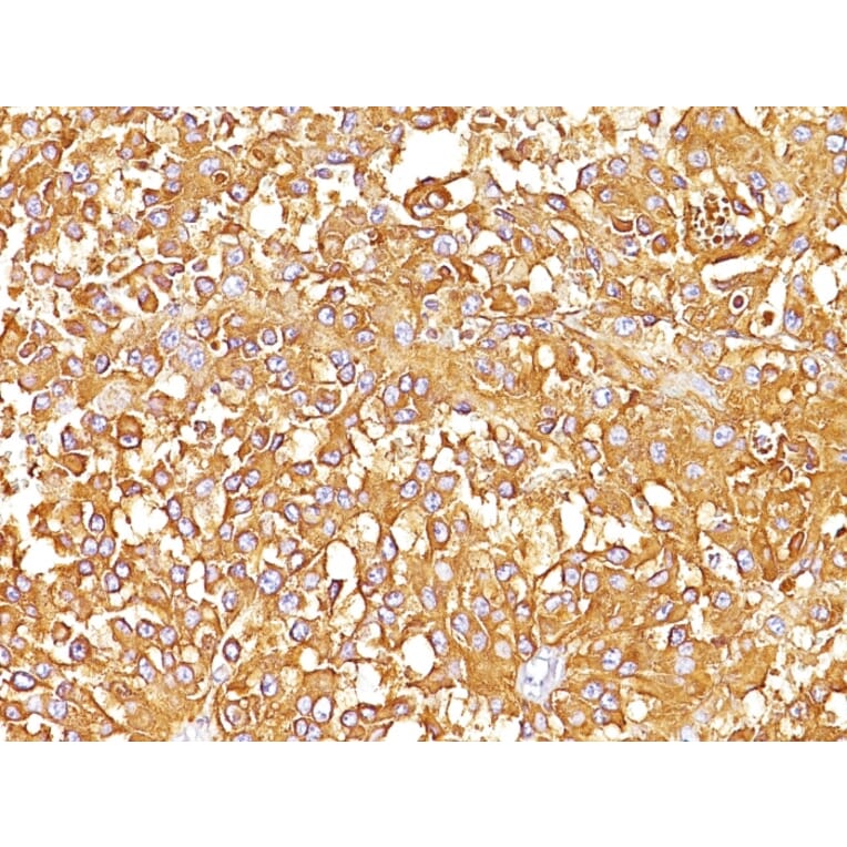 Immunohistochemistry - Anti-Melanoma gp100 Antibody [SPM142] - BSA and Azide free (A253147) - Antibodies.com
