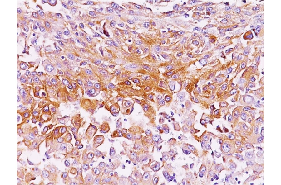 Immunohistochemistry - Anti-Melanoma gp100 Antibody [NKI-beteb] - BSA and Azide free (A253149) - Antibodies.com