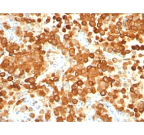 Immunohistochemistry - Anti-Melanoma gp100 Antibody [HMB45 + PMEL/783] - BSA and Azide free (A253151) - Antibodies.com
