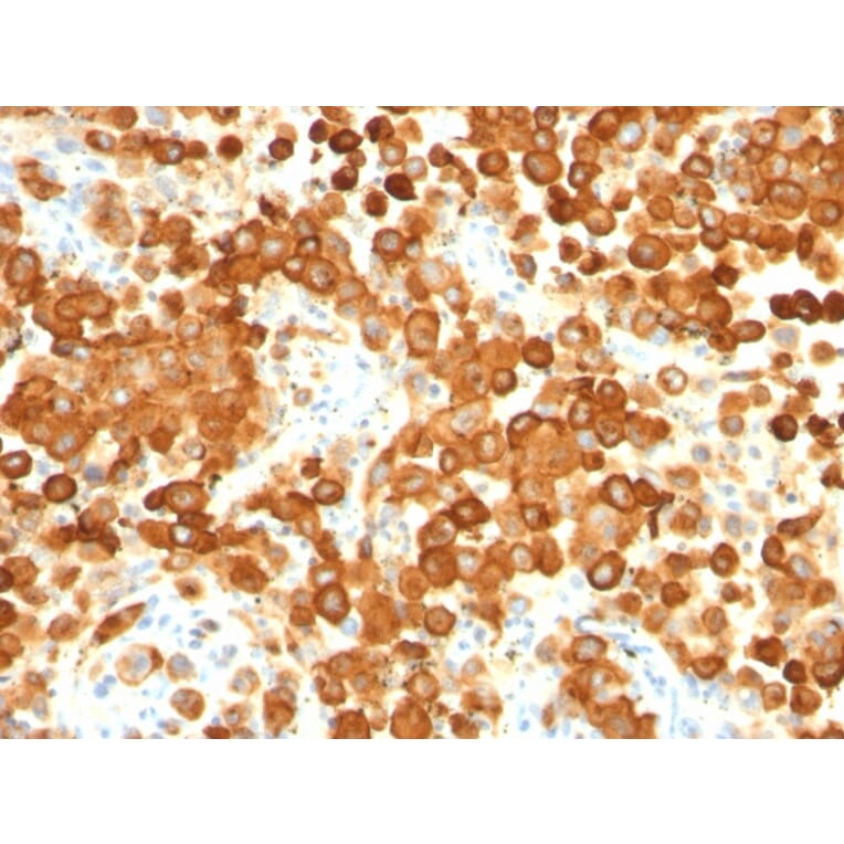 Immunohistochemistry - Anti-Melanoma gp100 Antibody [HMB45 + PMEL/783] - BSA and Azide free (A253151) - Antibodies.com