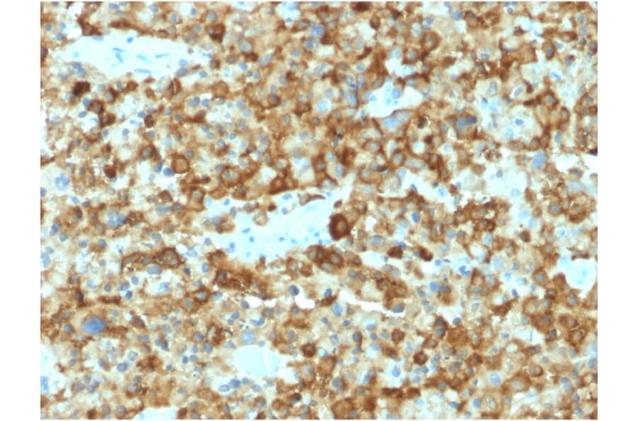 Immunohistochemistry - Anti-Melanoma gp100 Antibody [PMEL/2037] - BSA and Azide free (A253153) - Antibodies.com