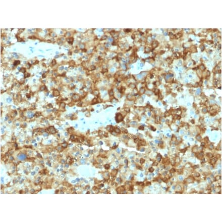 Immunohistochemistry - Anti-Melanoma gp100 Antibody [PMEL/2037] - BSA and Azide free (A253153) - Antibodies.com