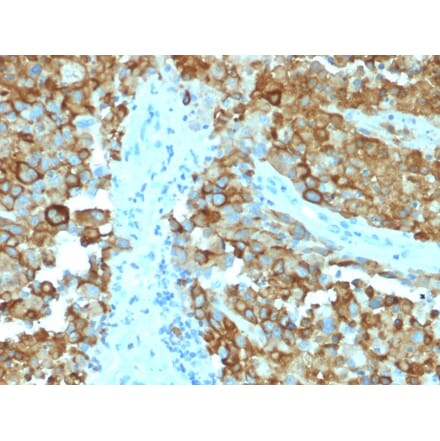 Immunohistochemistry - Anti-Melanoma gp100 Antibody [PMEL/2038] - BSA and Azide free (A253154) - Antibodies.com