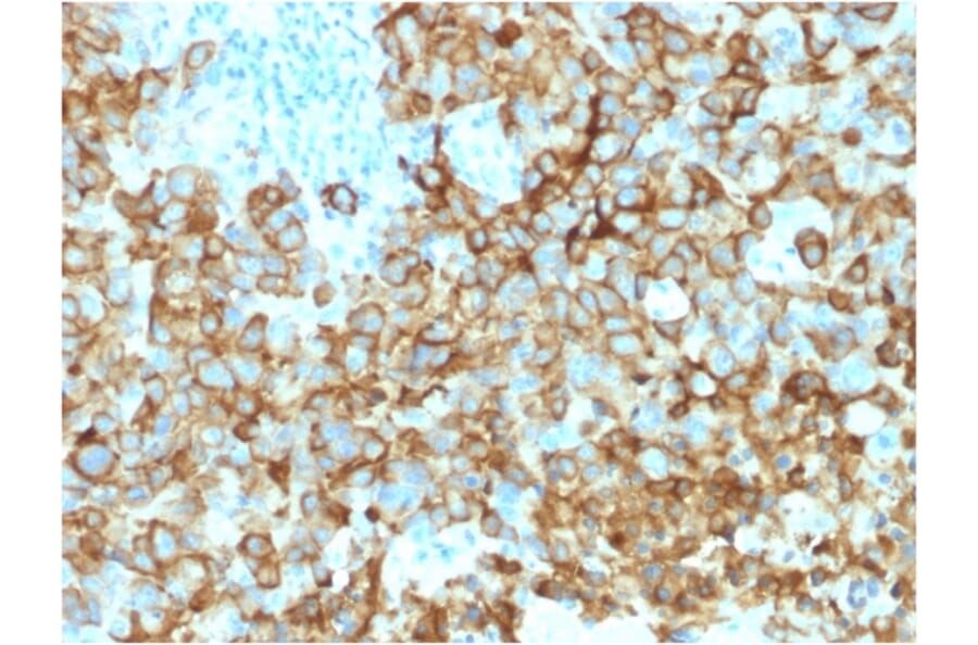 Immunohistochemistry - Anti-Melanoma gp100 Antibody [PMEL/2039] - BSA and Azide free (A253155) - Antibodies.com