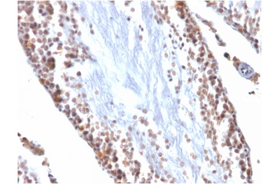 Immunohistochemistry - Anti-Wilms Tumor Protein Antibody [WT1/857] - BSA and Azide free (A253512) - Antibodies.com