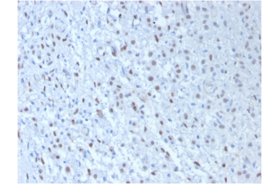 Immunohistochemistry - Anti-Wilms Tumor Protein Antibody [WT1/857 + 6F-H2] - BSA and Azide free (A253512) - Antibodies.com
