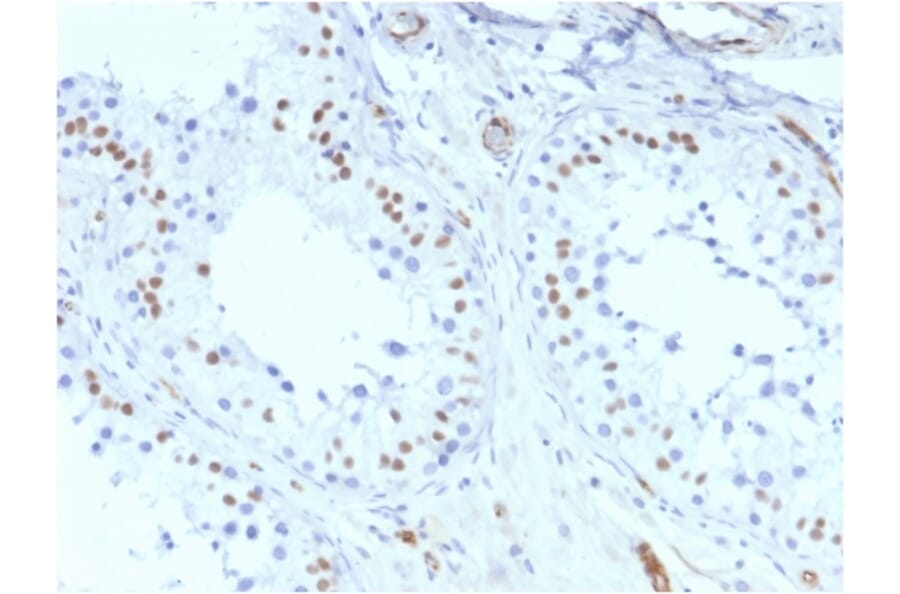 Immunohistochemistry - Anti-Wilms Tumor Protein Antibody [rWT1/857] - BSA and Azide free (A253514) - Antibodies.com