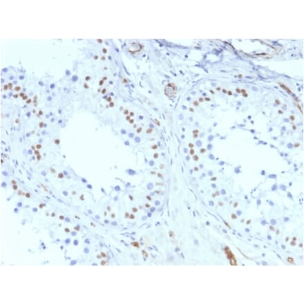 Immunohistochemistry - Anti-Wilms Tumor Protein Antibody [rWT1/857] - BSA and Azide free (A253514) - Antibodies.com