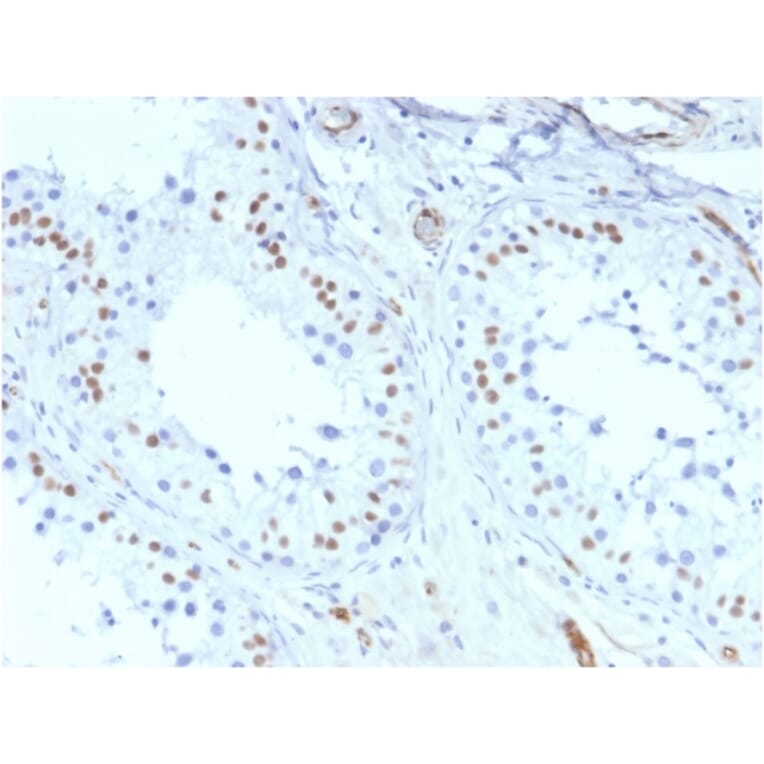 Immunohistochemistry - Anti-Wilms Tumor Protein Antibody [rWT1/857] - BSA and Azide free (A253514) - Antibodies.com