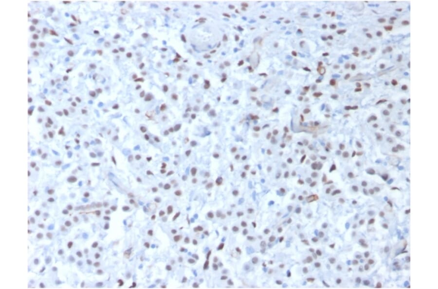 Immunohistochemistry - Anti-Wilms Tumor Protein Antibody [rWT1/857] - BSA and Azide free (A253514) - Antibodies.com