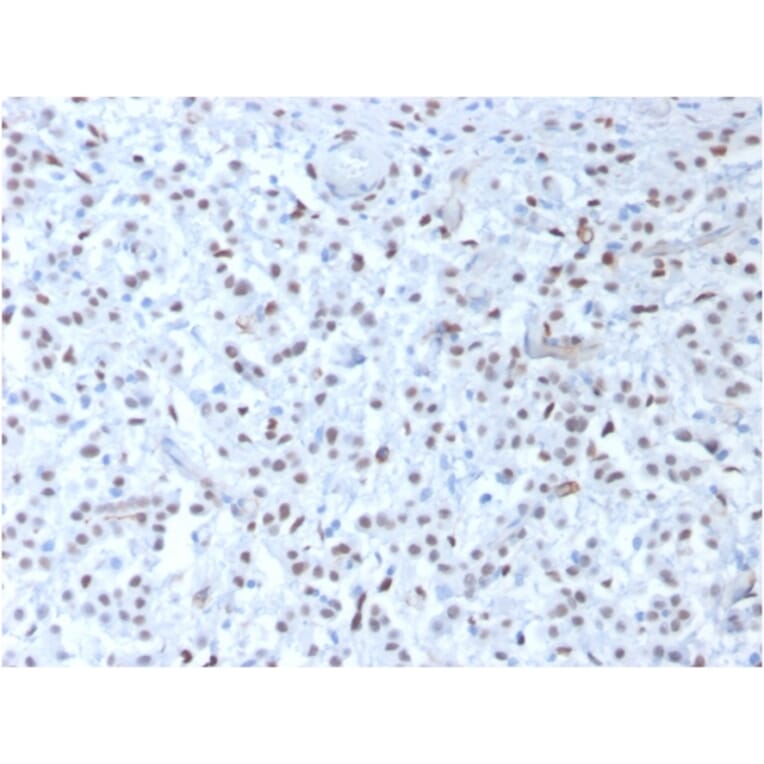 Immunohistochemistry - Anti-Wilms Tumor Protein Antibody [rWT1/857] - BSA and Azide free (A253514) - Antibodies.com