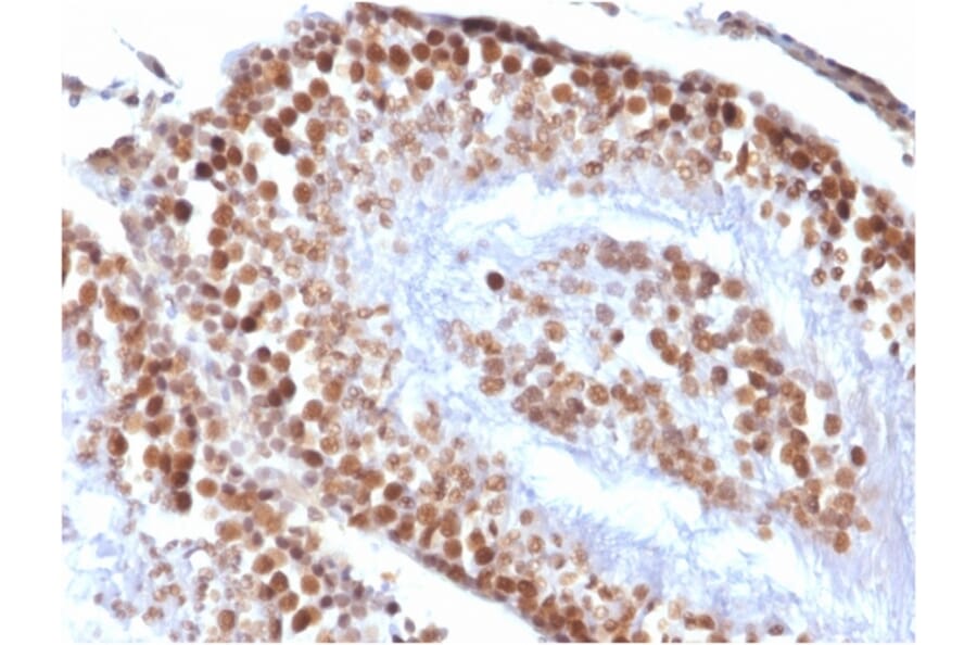 Immunohistochemistry - Anti-Wilms Tumor Protein Antibody [rWT1/857] - BSA and Azide free (A253514) - Antibodies.com