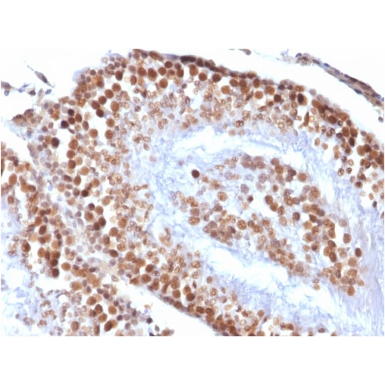 Immunohistochemistry - Anti-Wilms Tumor Protein Antibody [rWT1/857] - BSA and Azide free (A253514) - Antibodies.com