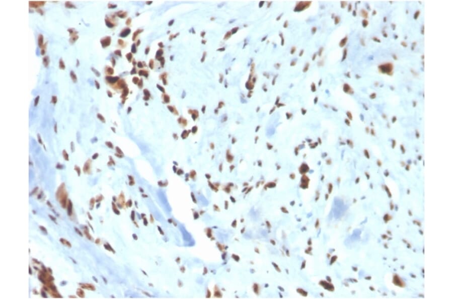 Immunohistochemistry - Anti-Wilms Tumor Protein Antibody [WT1/3477R] - BSA and Azide free (A253515) - Antibodies.com
