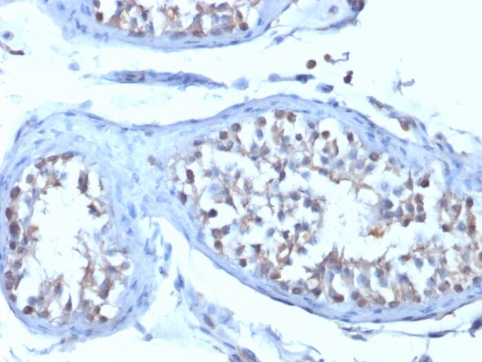 Immunohistochemical analysis of formalin-fixed, paraffin-embedded human testicular carcinoma using Anti-B7H4 Antibody [B7H4/1788].