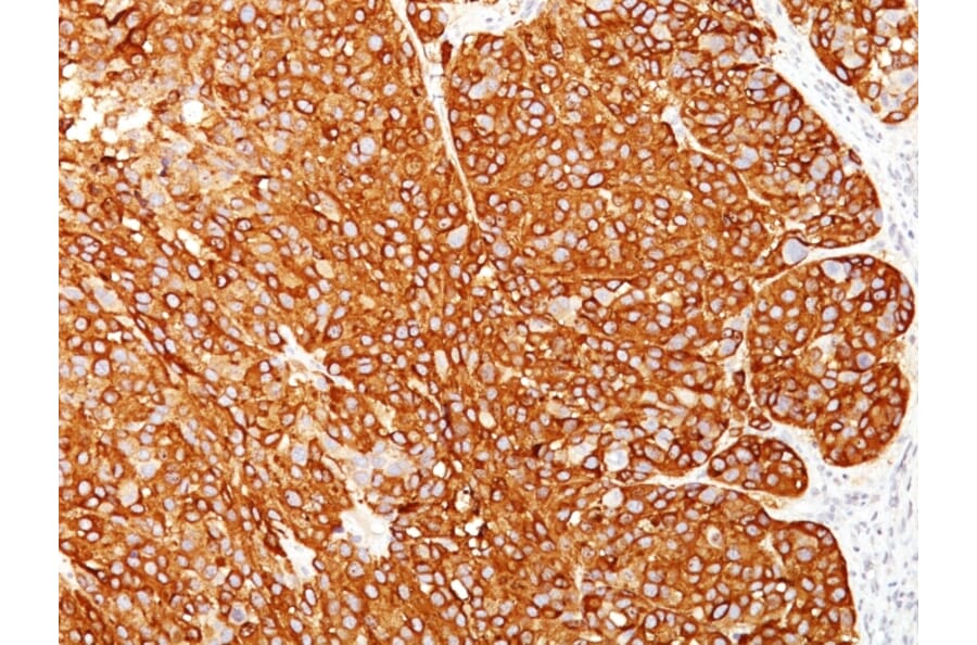 Immunohistochemistry - Anti-Melanoma Marker (MART-1 + Tyrosinase + gp100) Antibody [M2-7C10 + M2-9E3 + T311 + HMB45] - BSA and Azide free (A254069) - Antibodies.com