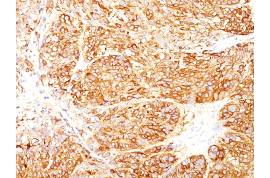 Immunohistochemistry - Anti-Melanoma Marker (MART-1 + gp100) Antibody [DT101+ BC199 + HMB45] - BSA and Azide free (A254140) - Antibodies.com