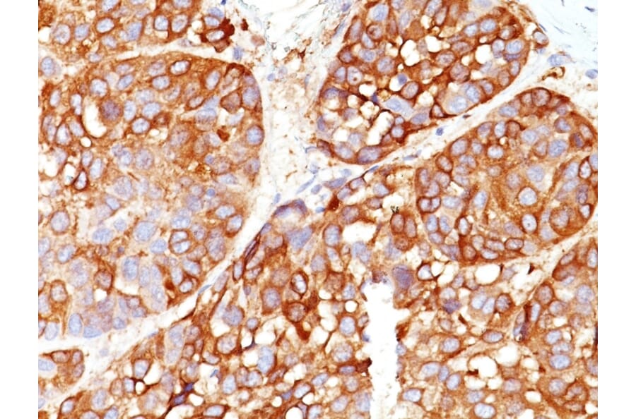 Immunohistochemistry - Anti-Melanoma Marker (MART-1 + Tyrosinase + gp100) Antibody [DT101+ BC199 + T311 + HMB45] - BSA and Azide free (A254155) - Antibodies.com