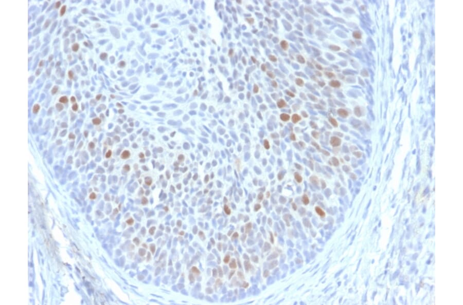 Immunohistochemistry - Anti-HPV16 E1 + E4 Antibody [HPV16 E1/E4] - BSA and Azide free (A254182) - Antibodies.com