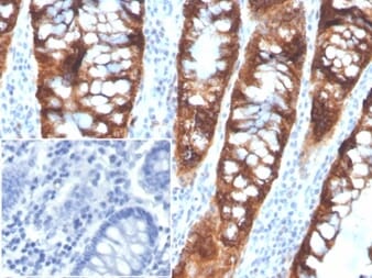 Immunohistochemical analysis of formalin-fixed, paraffin-embedded human colon tissue using Anti-PDGFB Antibody [PDGFB/3072]. Inset: PBS instead of the primary antibody. Secondary antibody negative control.
