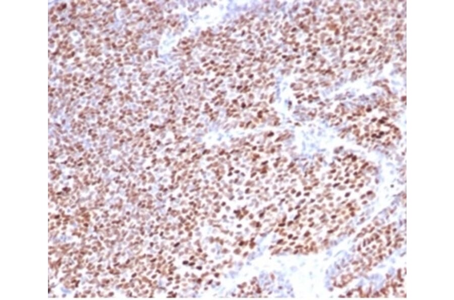 Immunohistochemistry - Anti-Progesterone Receptor Antibody [PGR/3817] (A277743) - Antibodies.com