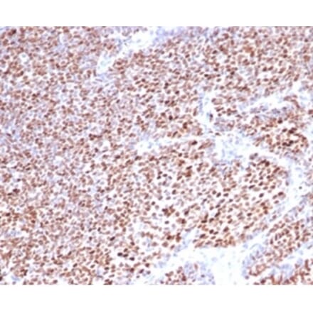 Immunohistochemistry - Anti-Progesterone Receptor Antibody [PGR/3817] (A277743) - Antibodies.com