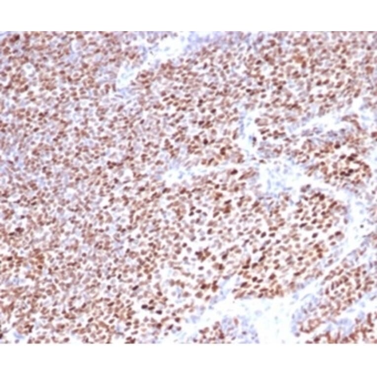 Immunohistochemistry - Anti-Progesterone Receptor Antibody [PGR/3817] (A277743) - Antibodies.com