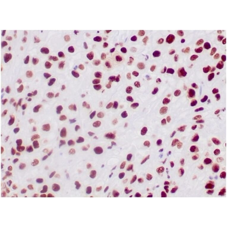 Immunohistochemistry - Anti-SNF5 Antibody [SMARCB1/3984] (A277794) - Antibodies.com