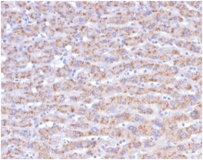 Immunohistochemical analysis of formalin-fixed, paraffin-embedded human liver carcinoma in colon tissue using Anti-CD40L Antibody [CD40LG/4675].