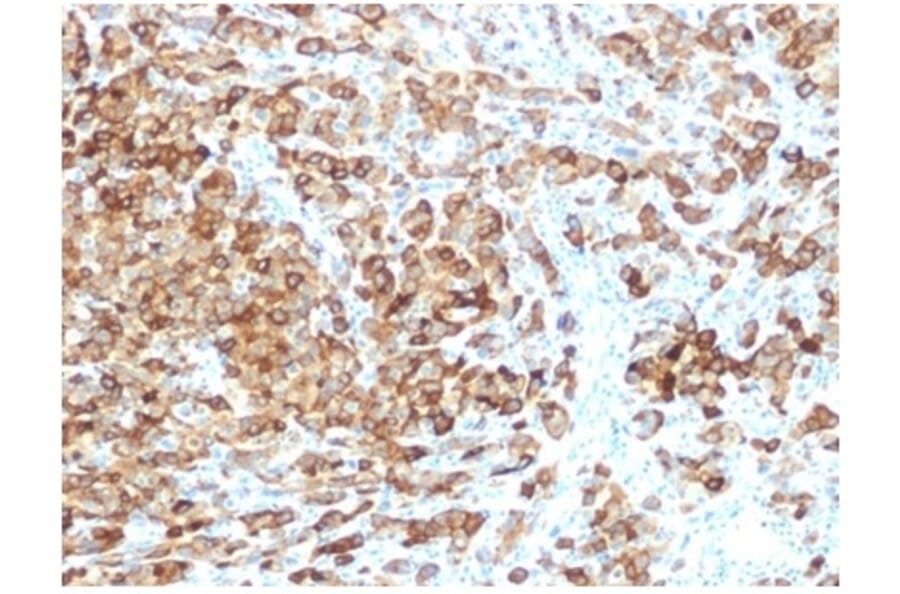 Immunohistochemistry - Anti-Melanoma gp100 Antibody [rPMEL17/6821] (A277918) - Antibodies.com