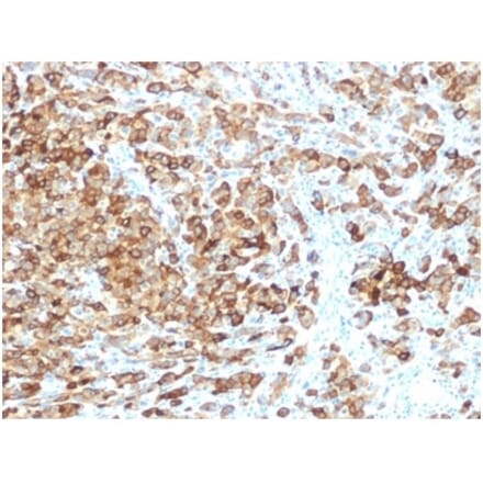 Immunohistochemistry - Anti-Melanoma gp100 Antibody [rPMEL17/6821] (A277918) - Antibodies.com