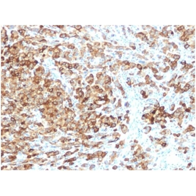 Immunohistochemistry - Anti-Melanoma gp100 Antibody [rPMEL17/6821] (A277918) - Antibodies.com