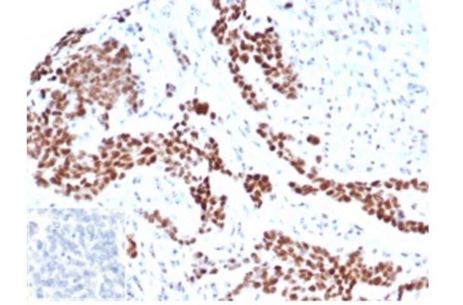 Immunohistochemistry - Anti-Wilms Tumor Protein Antibody [rWT1/6908] (A277929) - Antibodies.com