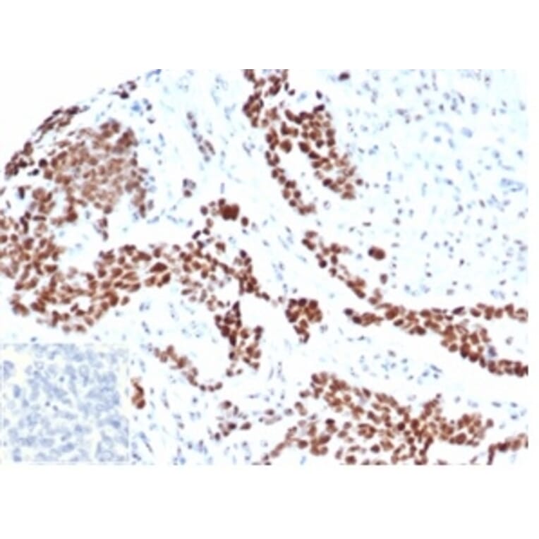 Immunohistochemistry - Anti-Wilms Tumor Protein Antibody [rWT1/6908] (A277929) - Antibodies.com